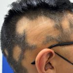 Alopecia areata