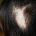 alopecia-areata-1