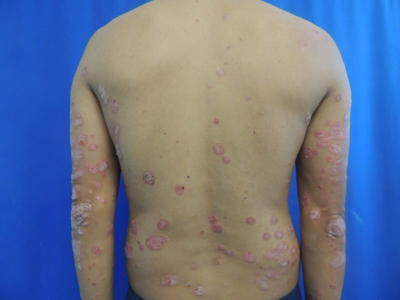 Psoriasis