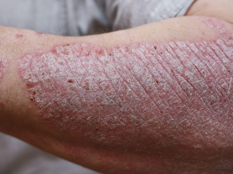 psoriasis-1